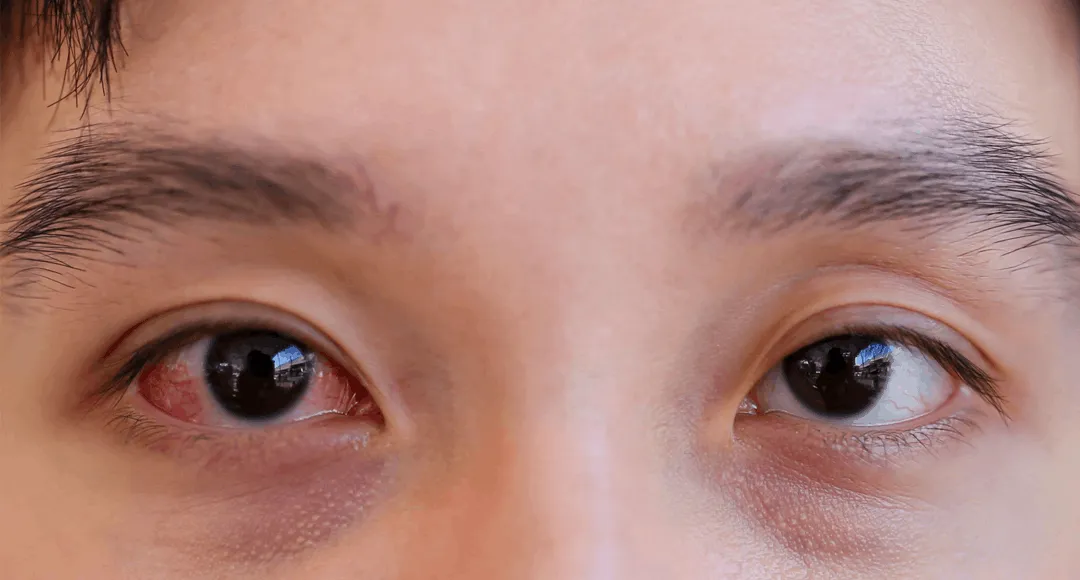 Common Eye Problems